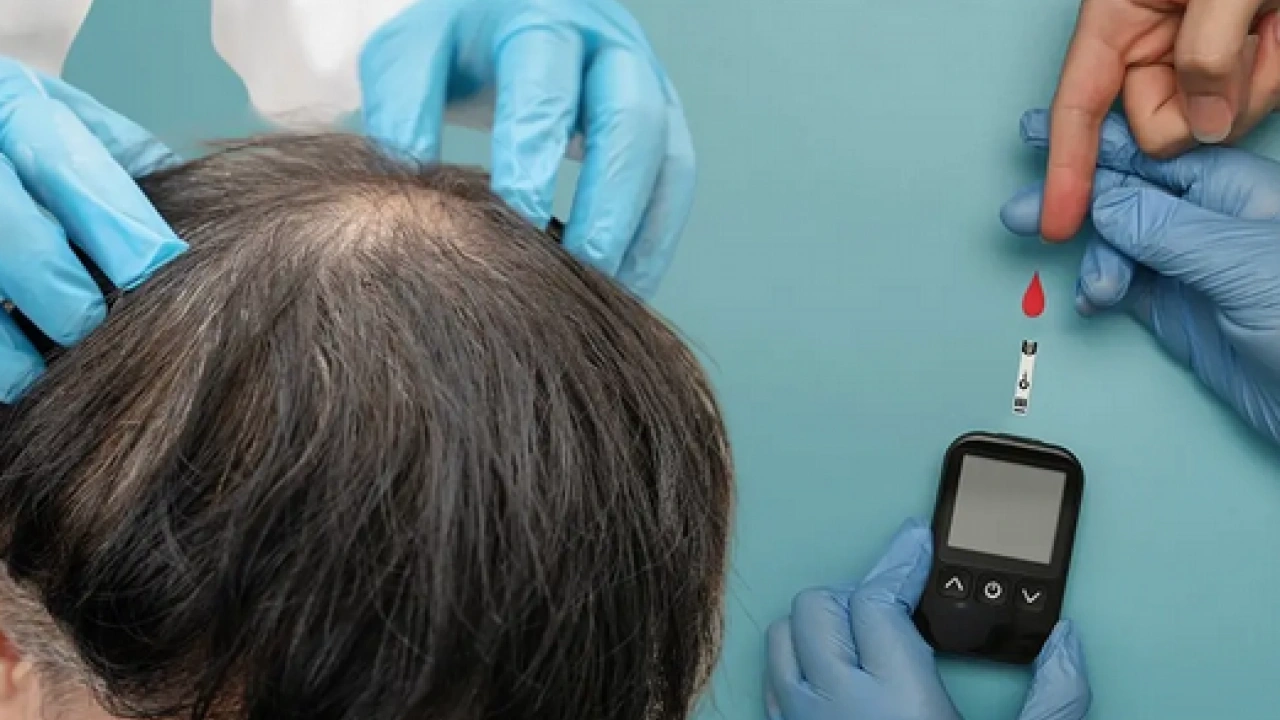 Foto - Bölgesel kellik diyabetin habercisi mi? Kellik deyip geçmemek lazım yoksa…