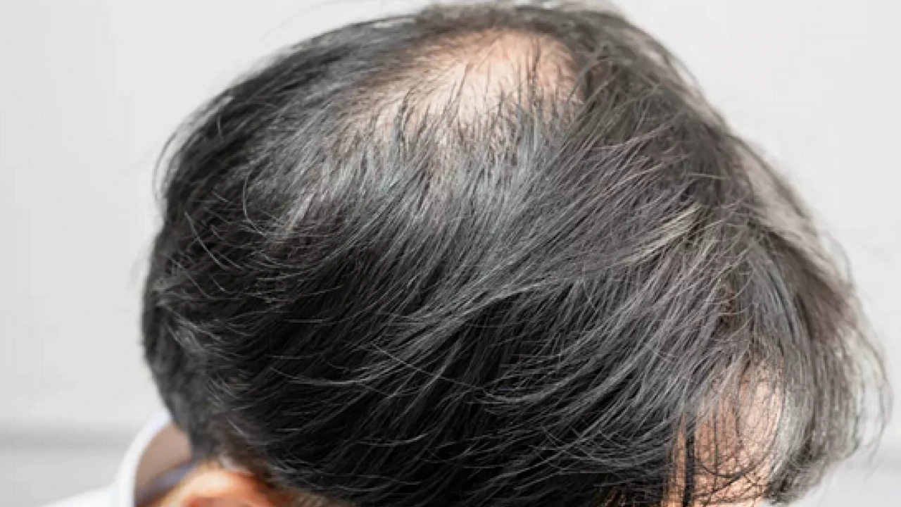 Foto - Bölgesel kellik diyabetin habercisi mi? Kellik deyip geçmemek lazım yoksa…