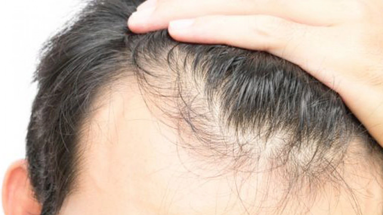 Foto - Bölgesel kellik diyabetin habercisi mi? Kellik deyip geçmemek lazım yoksa…