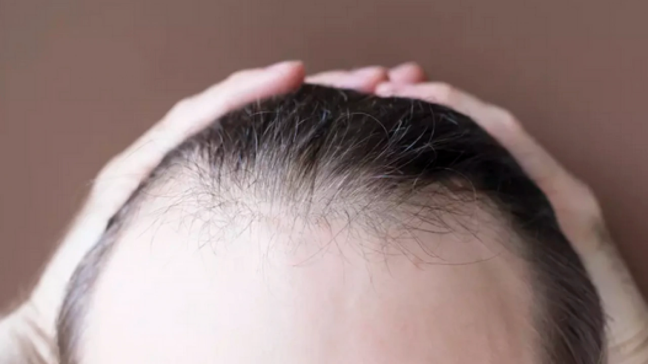 Foto - Bölgesel kellik diyabetin habercisi mi? Kellik deyip geçmemek lazım yoksa…