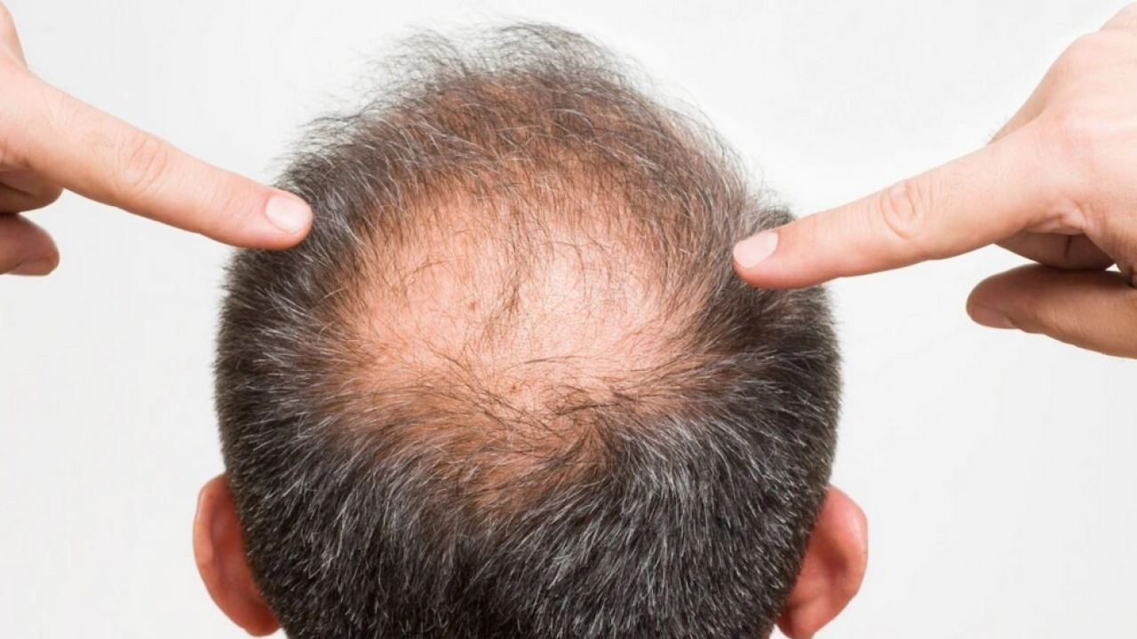 Bölgesel kellik diyabetin habercisi mi? Kellik deyip geçmemek lazım yoksa…