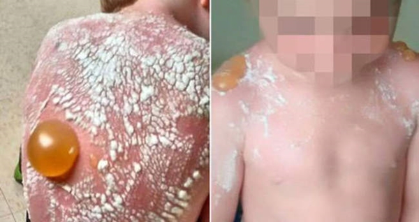 Foto - Böyle güneş yanığı görülmedi!