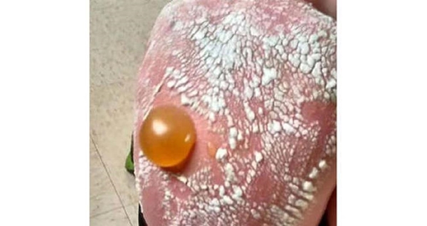 Foto - Böyle güneş yanığı görülmedi!