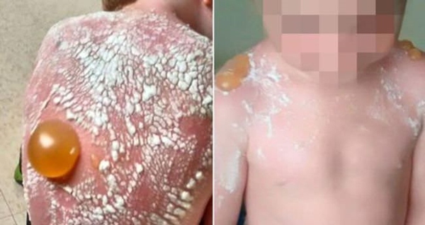 Foto - Böyle güneş yanığı görülmedi!