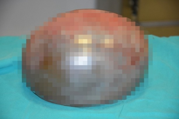 Foto - Böylesi görülmedi! Futbol topu büyüklüğünde