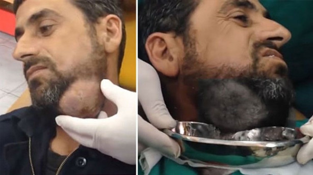 Boynundaki kitleye neşteri vurunca gözlerine inanamadılar!