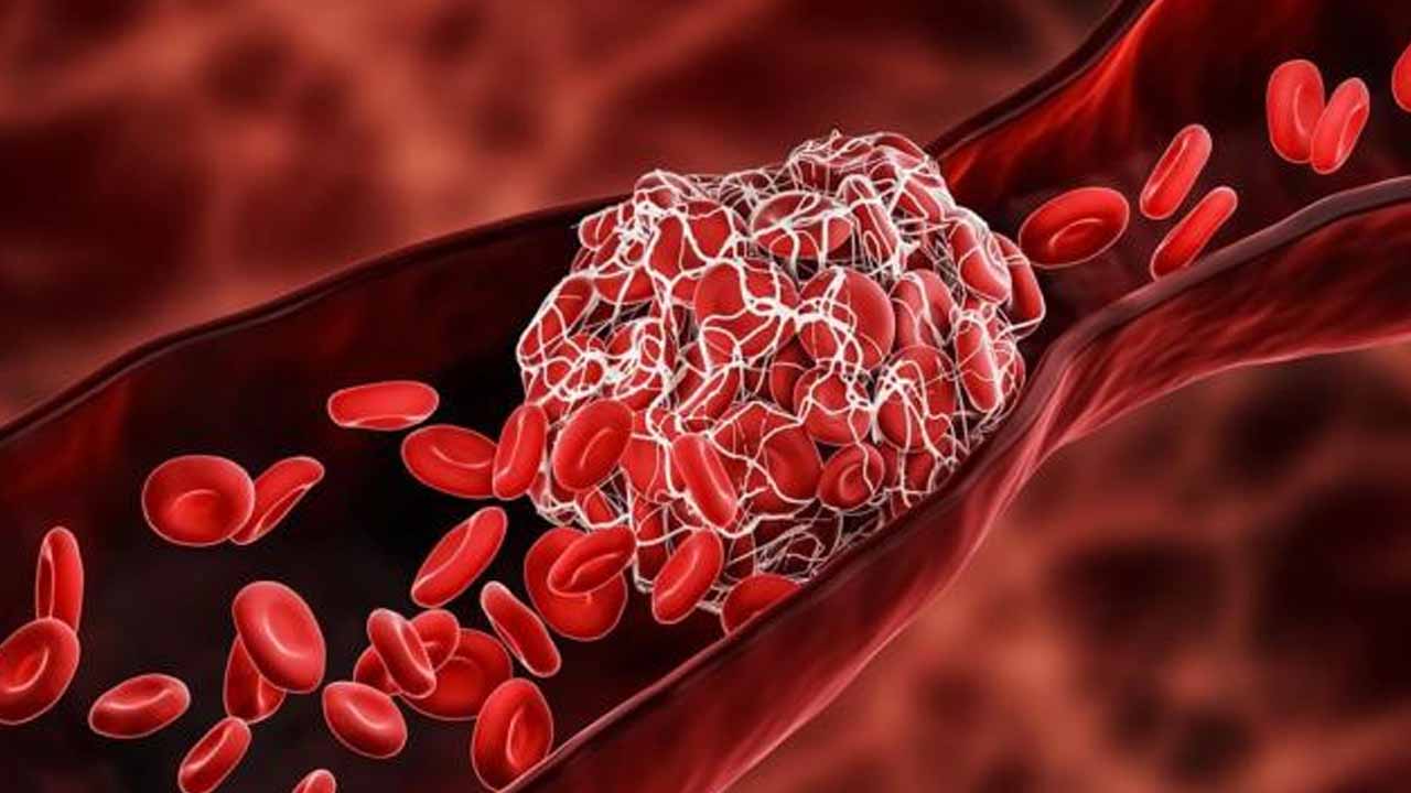 Foto - Bu 5 belirtiye dikkat! İşte bacaklarda kan pıhtısının sebebi