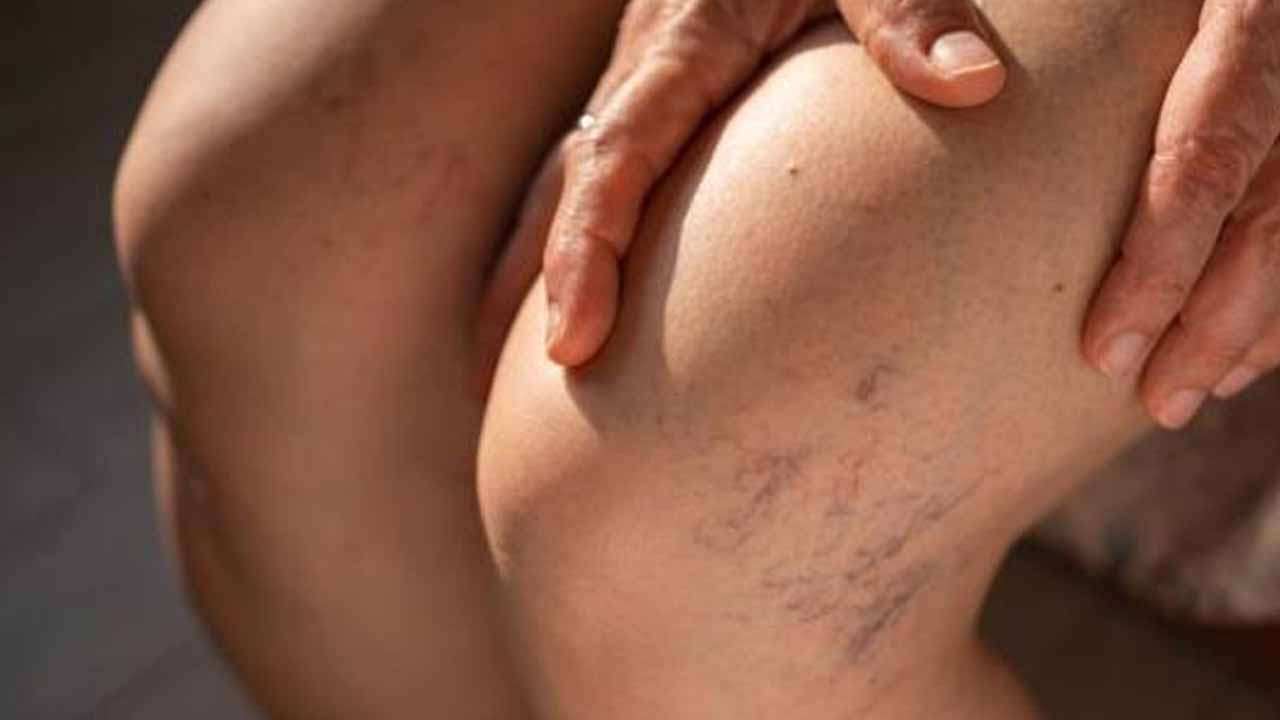 Bu 5 belirtiye dikkat! İşte bacaklarda kan pıhtısının sebebi