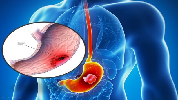Foto - Bu 5 belirtiye dikkat! Mide kanseri olabilirsiniz