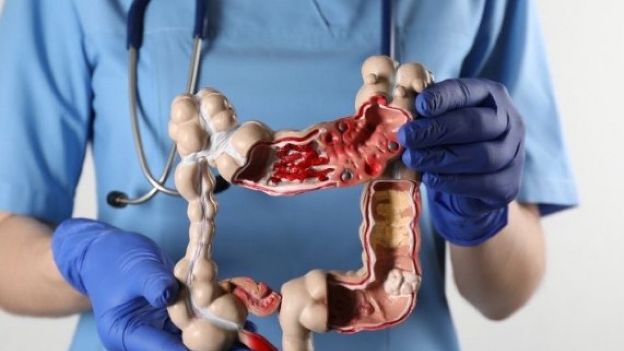 Foto - Bu alıkşanlıklardan hemen kurtulun: Kolon kanerine neden oluyor!