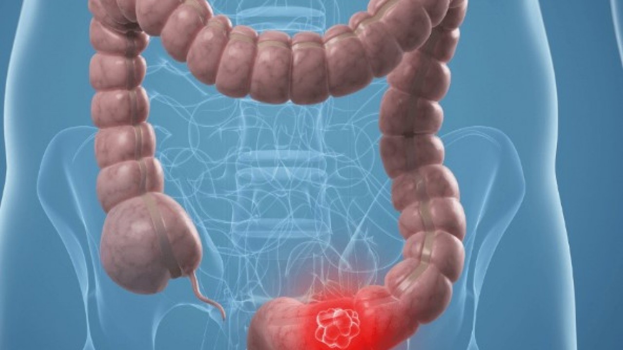 Foto - Bu alıkşanlıklardan hemen kurtulun: Kolon kanerine neden oluyor!