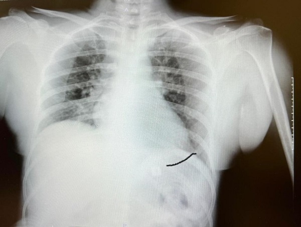 Foto - Bu ameliyat Türkiye'de yapıldı! Tıp literatüründe ender görülen olay