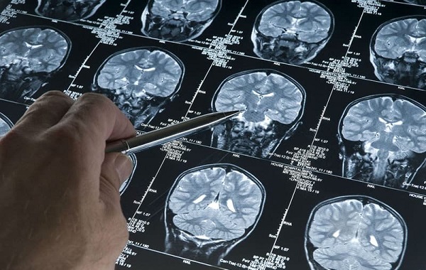 Foto - Bu belirtiler hep göz ardı ediliyor! Oysa hastalık 10 yıl öncesinden teşhis edilebilir