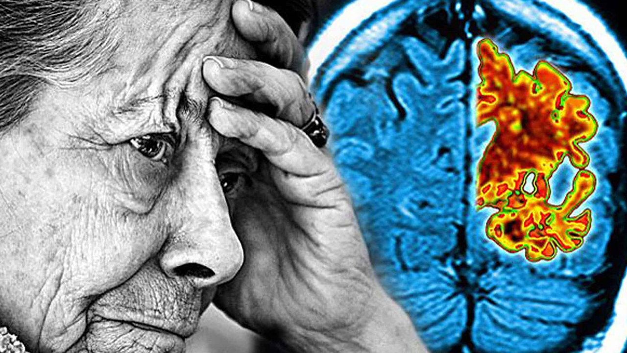Bu belirtiler yaşlılık değil, alzheimer olabilir! Unutkanlık mı, tehlike mi? İşte 10 kritik işaret!