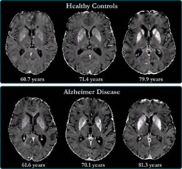 Foto - Bu belirtilere dikkat edin! Alzheimer'ın habercileri 6 yıl önce ortaya çıkıyor