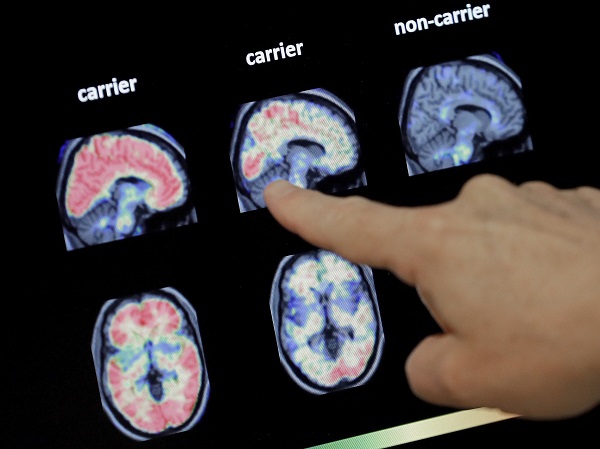 Foto - Bu belirtilere dikkat edin! Alzheimer'ın habercileri 6 yıl önce ortaya çıkıyor