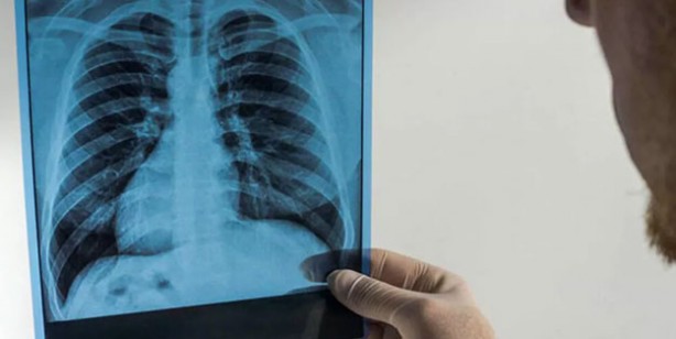 Bu besinler Akciğerleri temizliyor