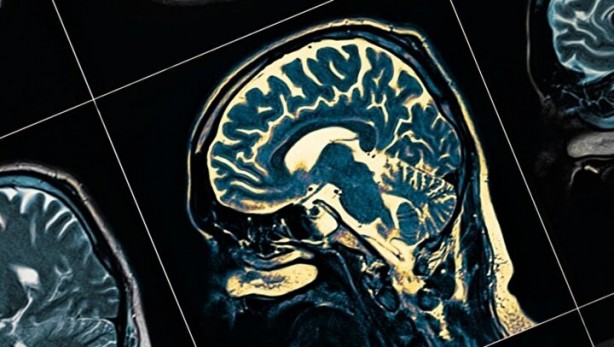 Foto - Bu besinlerden uzak durun! Beynin yaşlanmasını hızlandırıyor