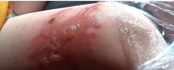 Foto - Bu bitki dünyayı ayağa kaldırdı! Maalesef Türkiye'de de var, dokunanın başına bakın neler geliyor