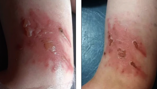 Foto - Bu bitki dünyayı ayağa kaldırdı! Maalesef Türkiye'de de var, dokunanın başına bakın neler geliyor