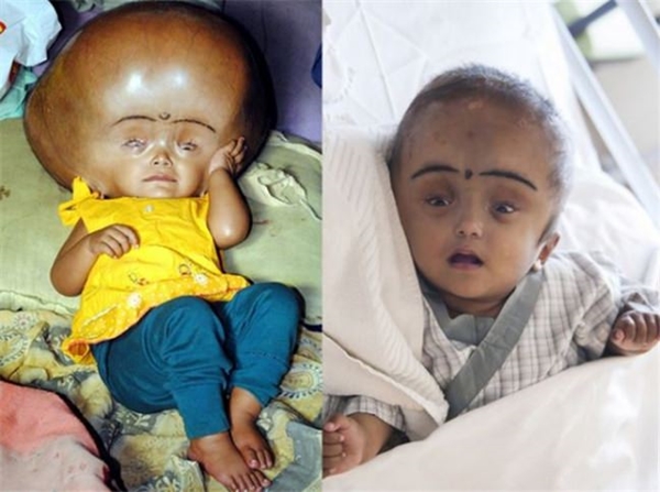 Foto - Bu çocuğun kafası tam 9 kilo ağırlığında!