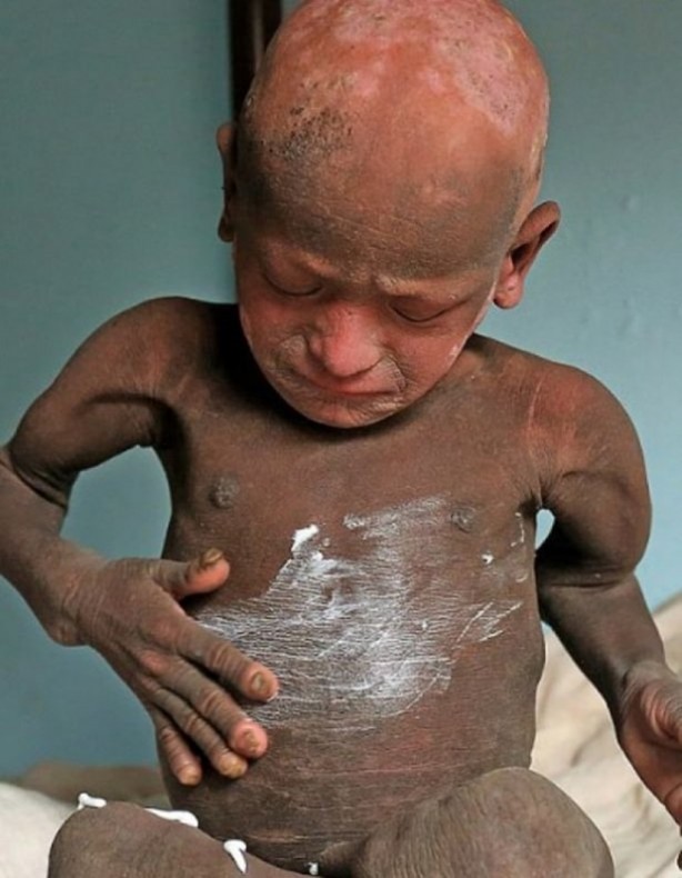 Foto - Bu çocuk yavaş yavaş taşa dönüşüyor!