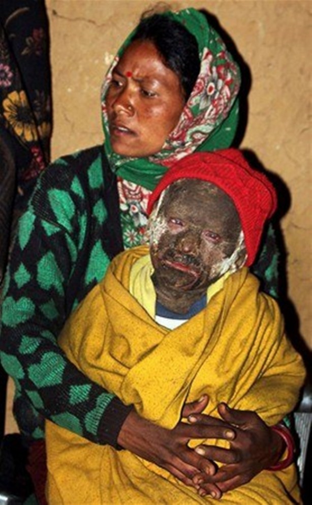 Foto - Bu çocuk yavaş yavaş taşa dönüşüyor!