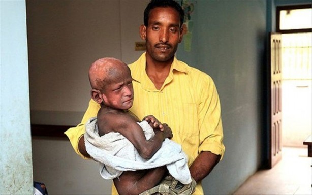 Foto - Bu çocuk yavaş yavaş taşa dönüşüyor!