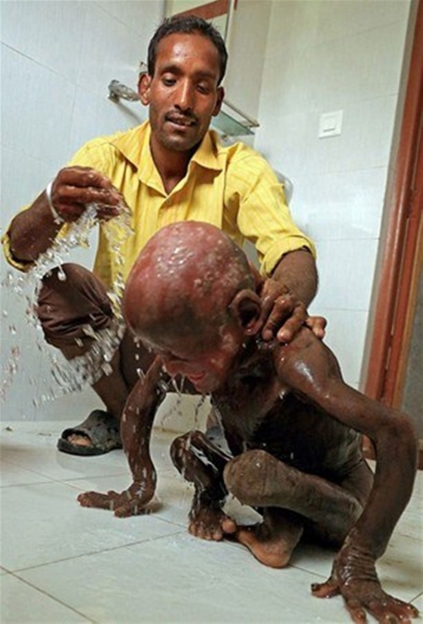 Foto - Bu çocuk yavaş yavaş taşa dönüşüyor!