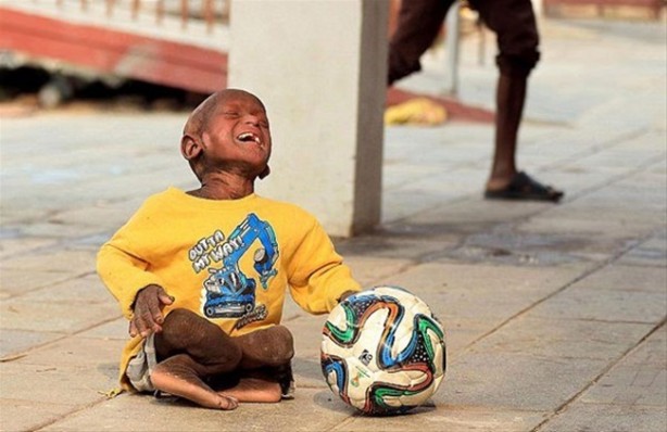 Foto - Bu çocuk yavaş yavaş taşa dönüşüyor!