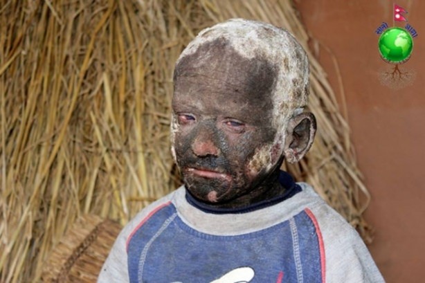 Foto - Bu çocuk yavaş yavaş taşa dönüşüyor!