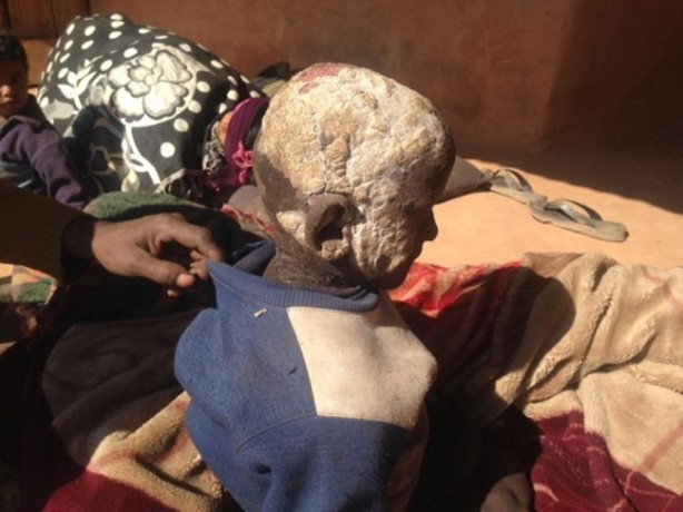 Foto - Bu çocuk yavaş yavaş taşa dönüşüyor!