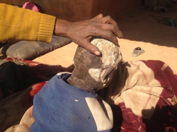 Foto - Bu çocuk yavaş yavaş taşa dönüşüyor!