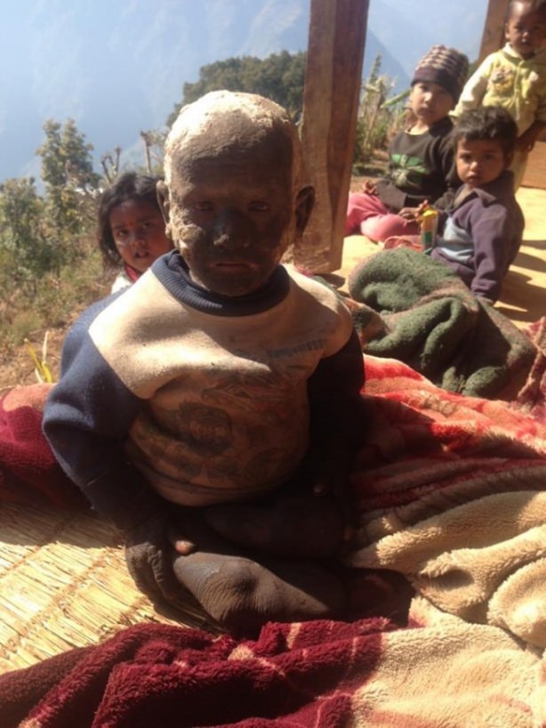 Foto - Bu çocuk yavaş yavaş taşa dönüşüyor!