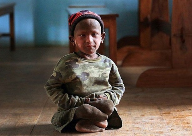 Foto - Bu çocuk yavaş yavaş taşa dönüşüyor!