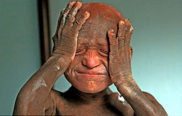 Bu çocuk yavaş yavaş taşa dönüşüyor!