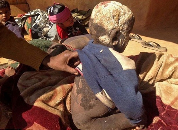 Foto - Bu çocuk yavaş yavaş taşa dönüşüyor!