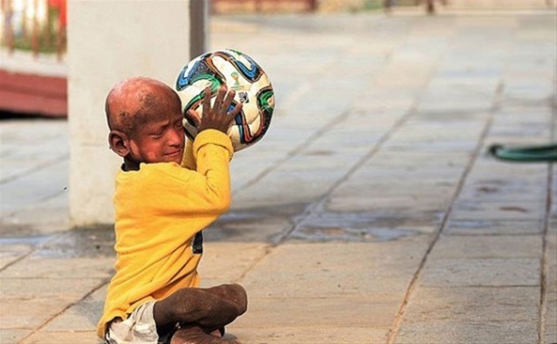 Foto - Bu çocuk yavaş yavaş taşa dönüşüyor!