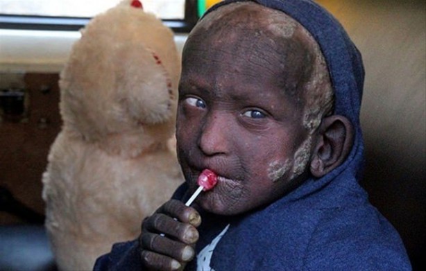 Foto - Bu çocuk yavaş yavaş taşa dönüşüyor!