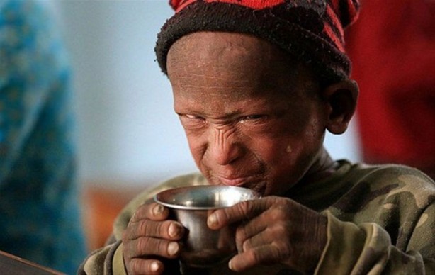 Foto - Bu çocuk yavaş yavaş taşa dönüşüyor!