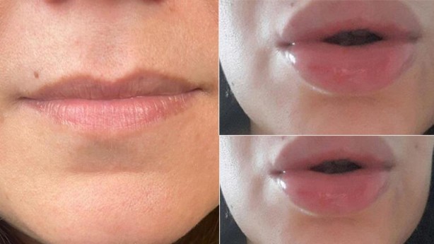 Foto - Bu diş macununu kullananlar dikkat! Dudakları yanakları şişiriyor