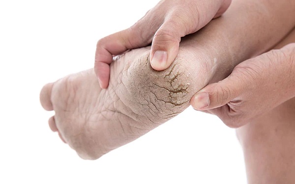 Foto - Bu formül işinize bir hayli yarayacak! Topuk çatlaklarından böyle kurtulun