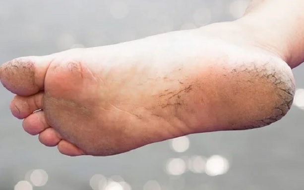 Foto - Bu formül işinize bir hayli yarayacak! Topuk çatlaklarından böyle kurtulun