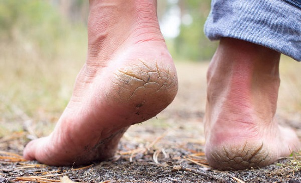 Bu formül işinize bir hayli yarayacak! Topuk çatlaklarından böyle kurtulun
