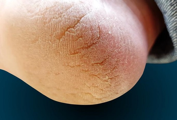 Foto - Bu formül işinize bir hayli yarayacak! Topuk çatlaklarından böyle kurtulun