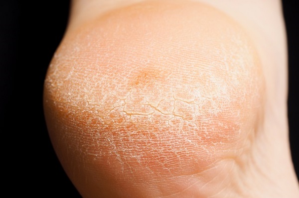 Foto - Bu formül işinize bir hayli yarayacak! Topuk çatlaklarından böyle kurtulun