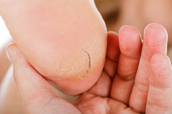 Foto - Bu formül işinize bir hayli yarayacak! Topuk çatlaklarından böyle kurtulun