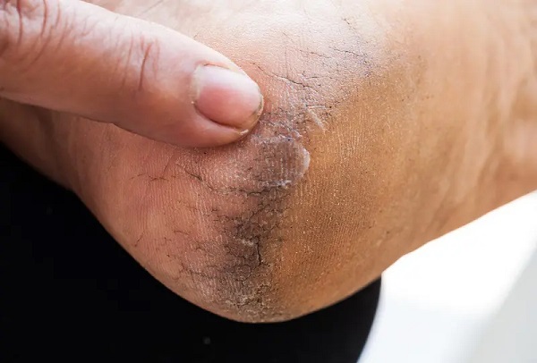 Foto - Bu formül işinize bir hayli yarayacak! Topuk çatlaklarından böyle kurtulun