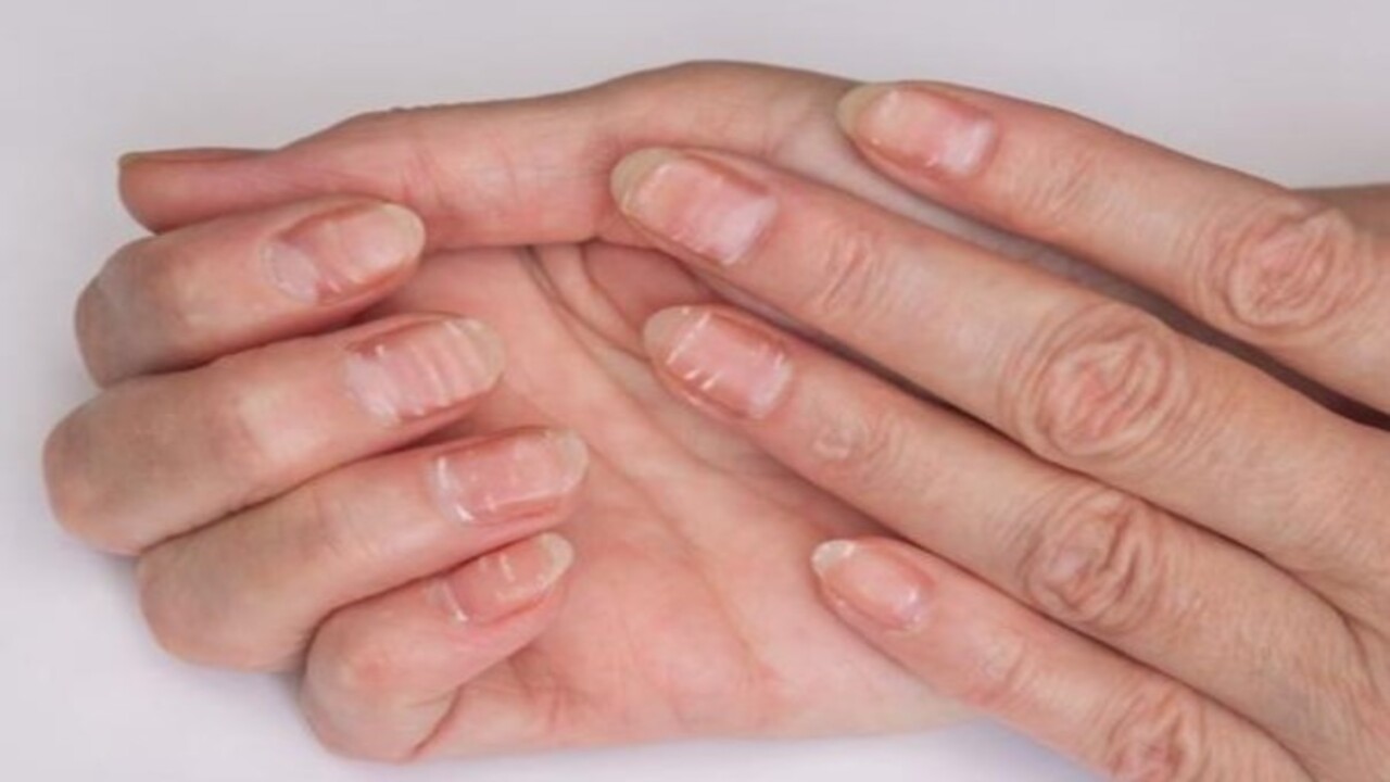 Foto - Bu hastalığın habercisiymiş! Tırnağınızda beyaz lekeler varsa dikkat