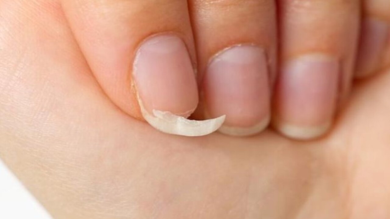 Foto - Bu hastalığın habercisiymiş! Tırnağınızda beyaz lekeler varsa dikkat
